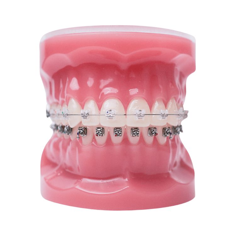Clear braces