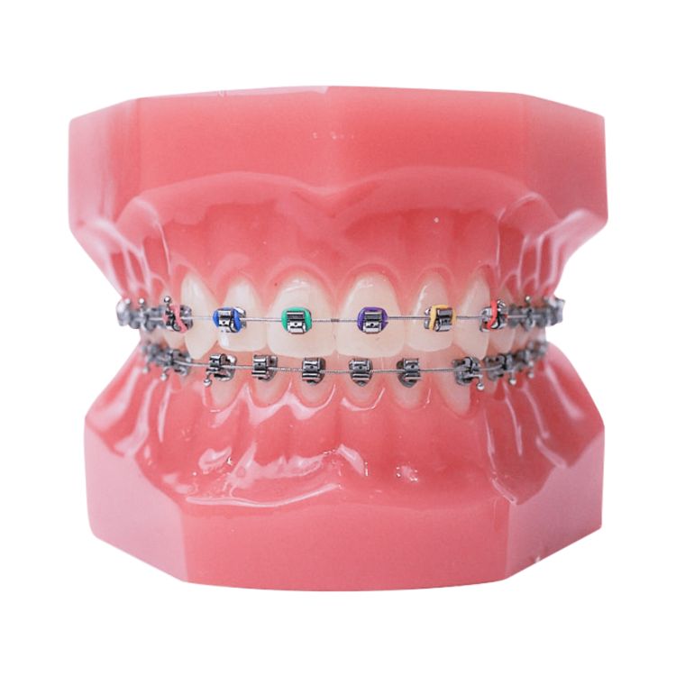 Metal braces