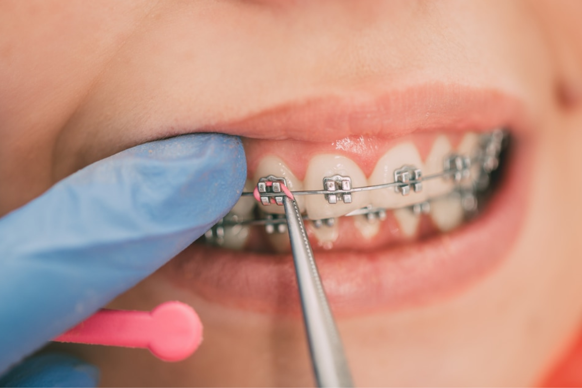 What Foods Can I eat with Braces?