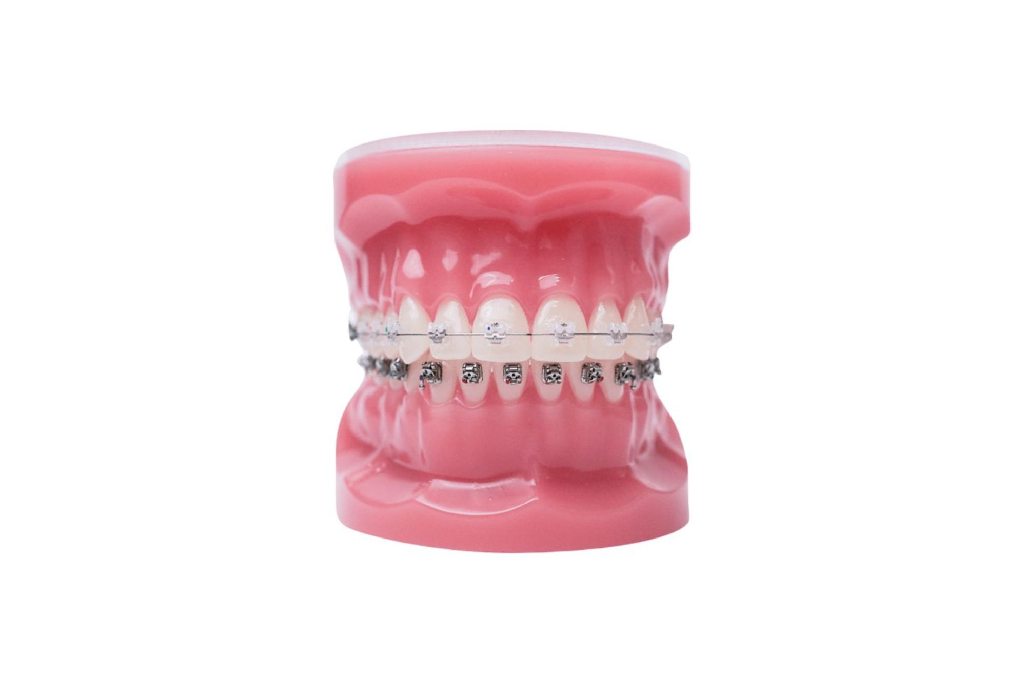 Clear Braces - Austin Orthodontic Arts - Austin Orthodontist
