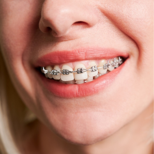 braces treatment in austin