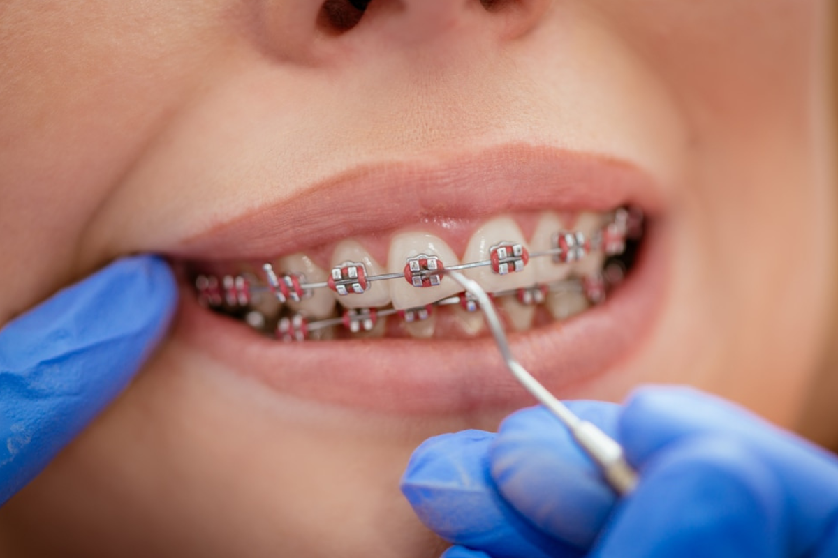 Is It Too Late to Have Braces as an Adult?