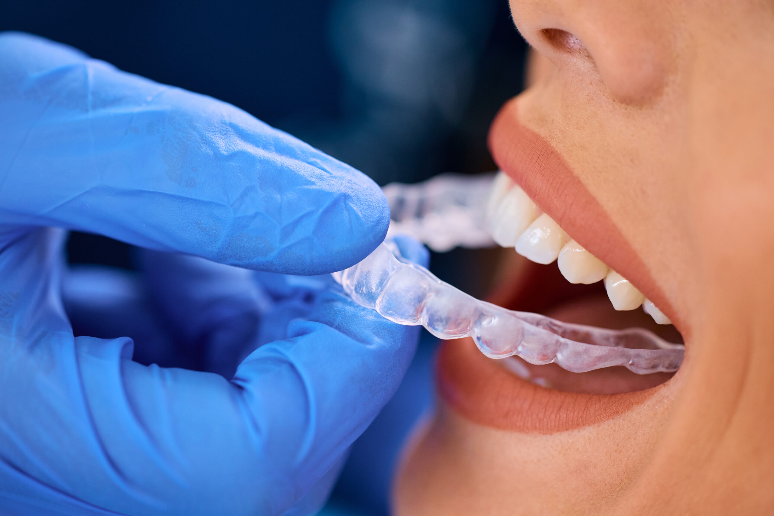How Long Does Clear Aligner Treatment Take?