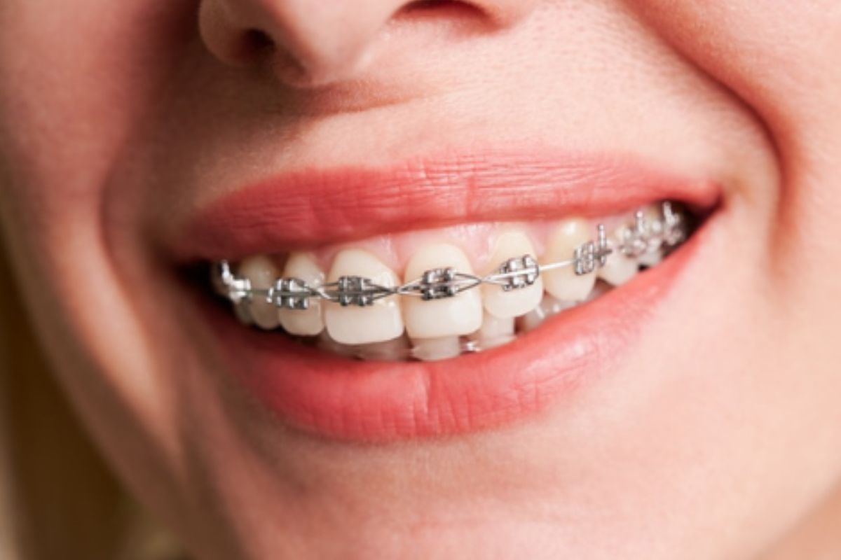 How Long Do You Need to Wear Braces?