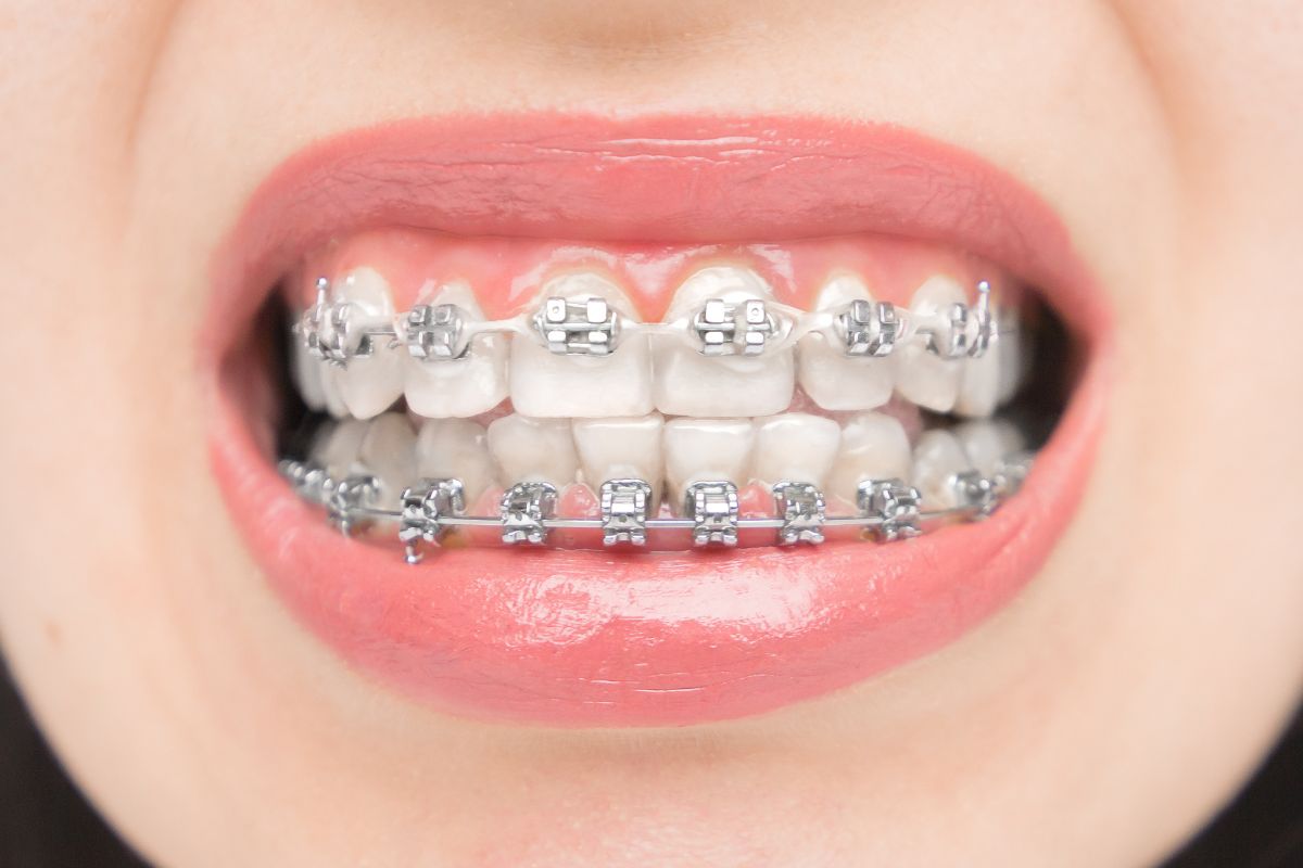 What Causes Crooked Teeth in Kids? A Parent’s Guide