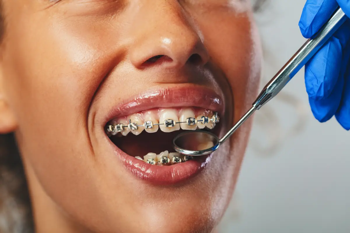 Metal braces installation