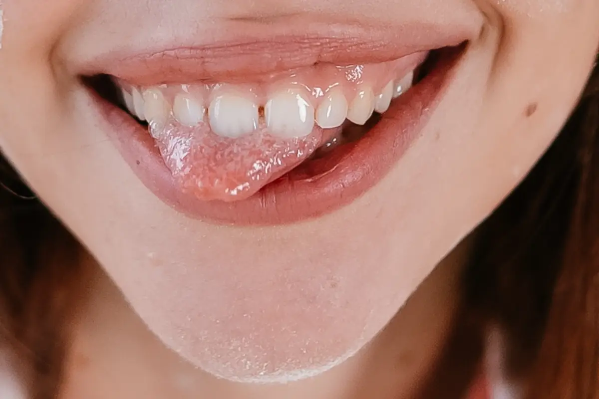 Front teeth sticking out - Austin Orthodontic Arts