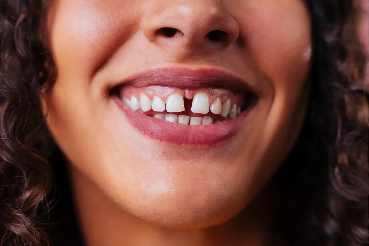How to fix gaps between my teeth